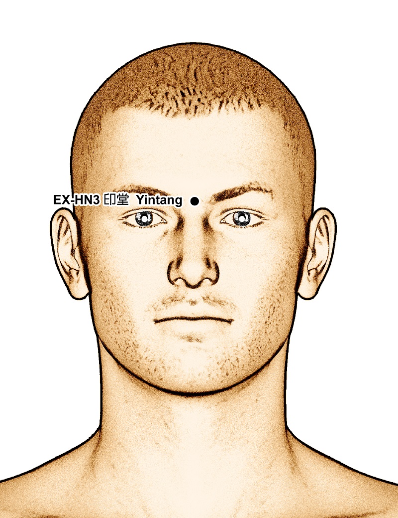 presopunctura, punctul Yintang de presopunctura