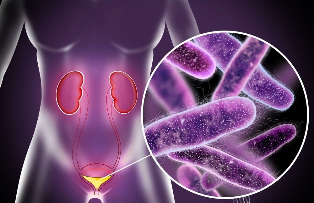 cistita, infectie urinara, tratamente naturiste cistita
