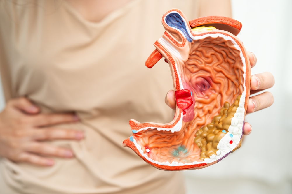 Alimente pentru profilaxia cancerului de colon