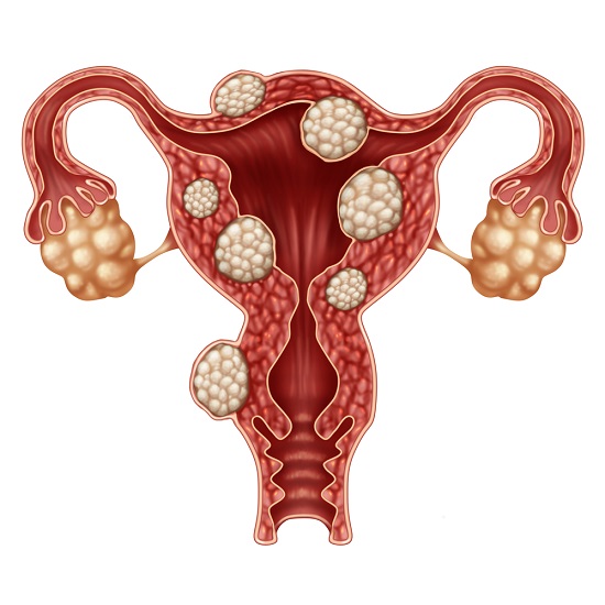 fibrom uterin