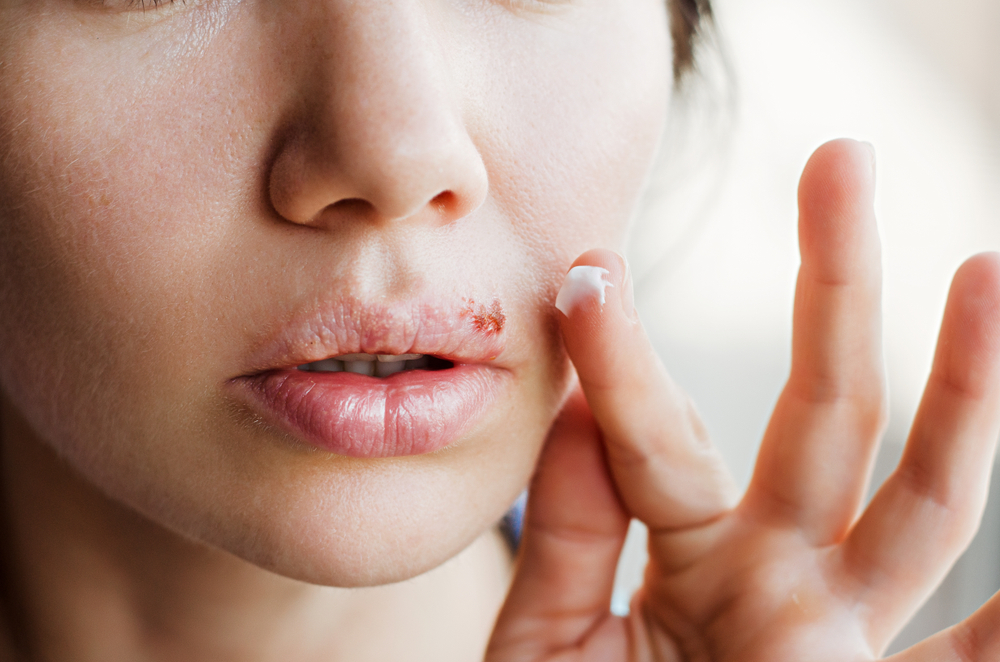 tratamente naturiste herpes la buza