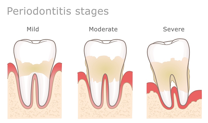 parodontita stadii