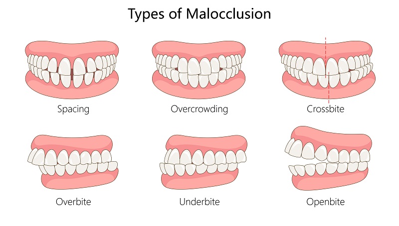tipuri de malocluzie