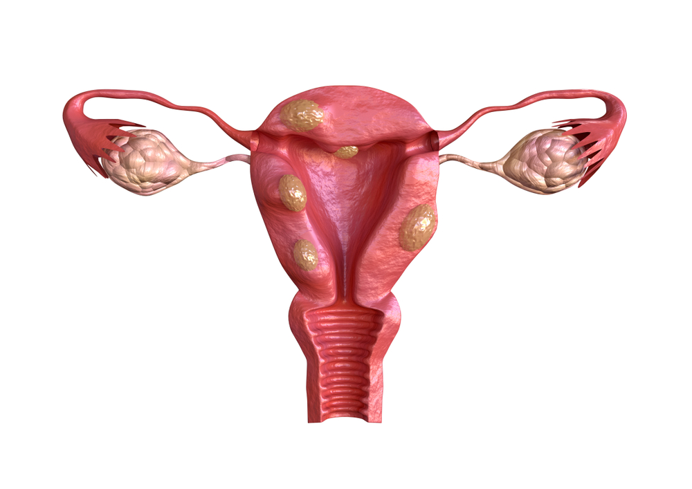 tratamente naturiste fibrom uterin