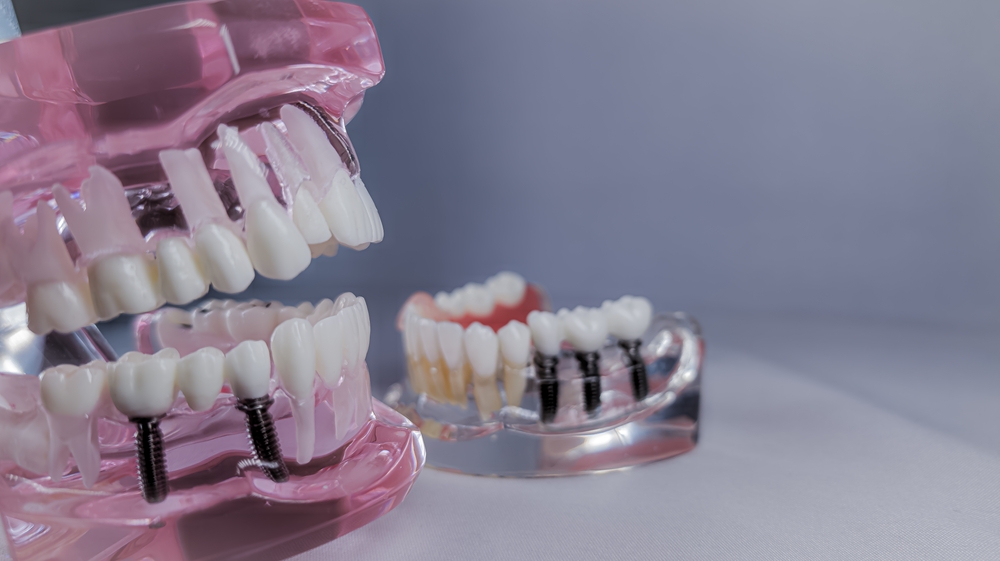 implant dentar