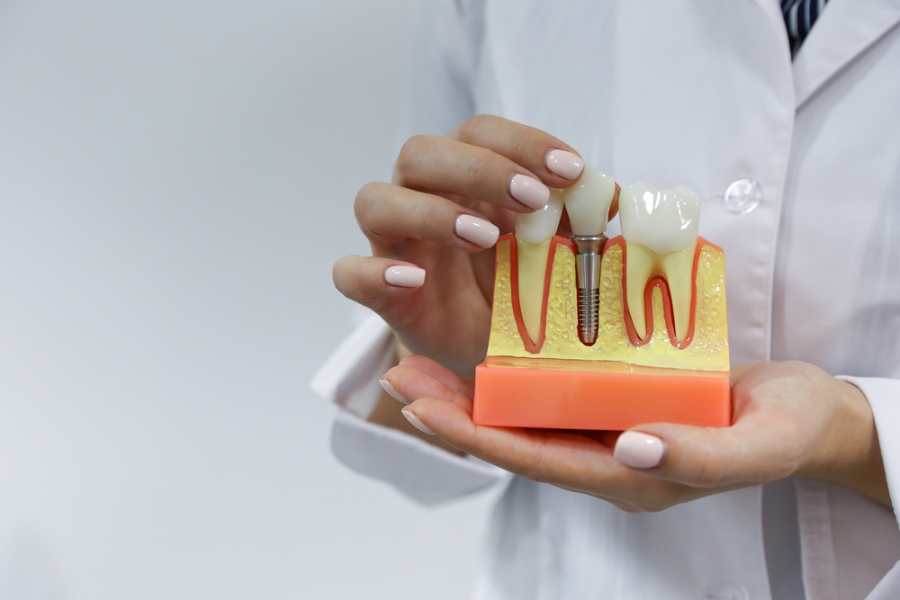 implant dentar