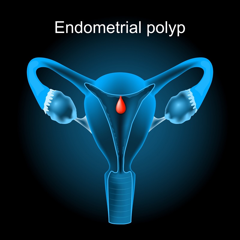 polipi endometriali