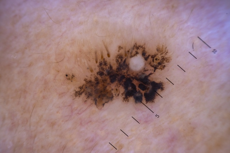 melanom cancer de piele