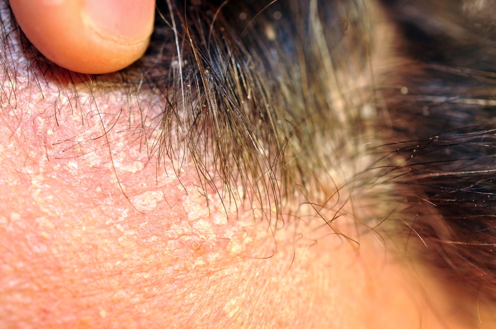 dermatita seboreica pe scalp