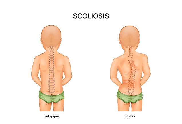 scolioza, afectiuni coloana