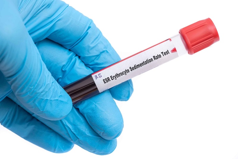 VSH marker antiinflamator
