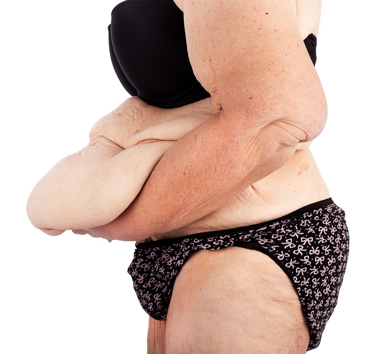 sort abdominal abdominoplastia