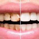 Legatura dintre obezitate si sanatatea orala