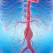 Ce este un anevrism aortic și cum se poate trata