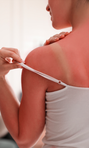 Piele care te mănâncă după soare și căldură? Remedii naturale blânde care pot calma iritația