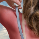 La ce riscuri de sănătate ne expun arsurile solare