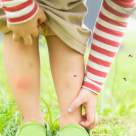 5 solutii pentru calmarea pielii dupa intepaturile de insecte