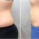 Lipoaspirația asistată laser: Inovație în estetica corporală, cu rezultate permanente