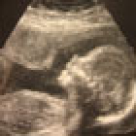 Ecografia in primul trimestru de sarcina