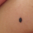 Alunitele la copii - motiv de ingrijorare sau nu?