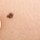 Cum indepartam alunitele: chirurgical sau cu laserul?