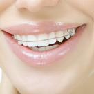 Ingrijirea aparatului dentar fix