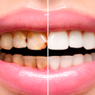 Caria dentară – ce este și cum se tratează