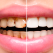 Caria dentară – ce este și cum se tratează