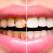 Caria dentară – ce este și cum se tratează
