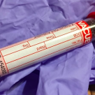 Limfocite crescute la adulti sau copii – ce inseamna