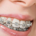 5 probleme ale dintilor pe care le poti trata cu aparatul dentar