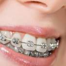 5 probleme ale dintilor pe care le poti trata cu aparatul dentar