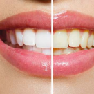 Albire dentara sau fatete - afla ce ti se potriveste mai bine