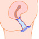 O metoda de contraceptie: prezervativele feminine