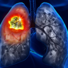 Respira Sanatate: Peste 4 milioane de romani au risc crescut de cancer pulmonar