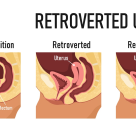 Uterul retrovers - ce înseamnă - detalii de la un medic ginecolog