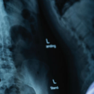 Spondiloza - simptome si tratament