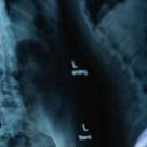 Spondiloza - simptome si tratament