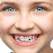 Dintii inghesuiti la copii - cauze si tratament 