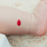 Hemangiomul infantil – cauze, tratament