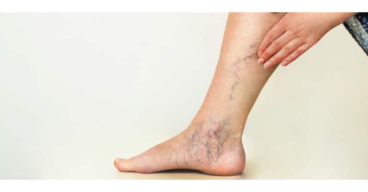 Рубрика: Care ajută la dureri la nivelul picioarelor cu vene varicoase reticulare