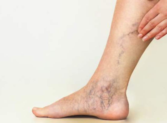 Cum doare picioarele cu varice, primul ajutor în lupta împotriva durerii - Ulcere 