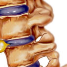 Hernia de disc - cauze si simptome 