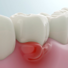 Parodontita, afecțiunea silențioasă care poate afecta întregul organism