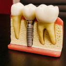 Implantul dentar: întrebări și răspunsuri pe care ai vrut să le afli dintotdeauna