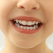 Explicațiile medicului ortodont: Aparatul dentar la copii -necesitate sau modă?