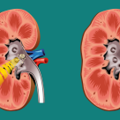 Scapă de pietrele la rinichi fără bisturiu! Litotriția extracoroporală cu unde de șoc, o soluție implementată cu succes de peste 10 ani la GRAL Medical
