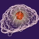 Cum tratăm tumorile cerebrale? Dr. Dan Mitrea: Există șase mari decizii terapeutice pe care pacientul și echipa multidisciplinară le pot lua