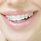 Afla daca esti un candidat potrivit pentru aparatul dentar