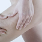 Pentru mamici: tratamente naturiste contra celulitei si vergeturilor